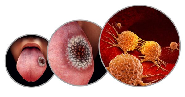 dépistage du cancer de la bouche