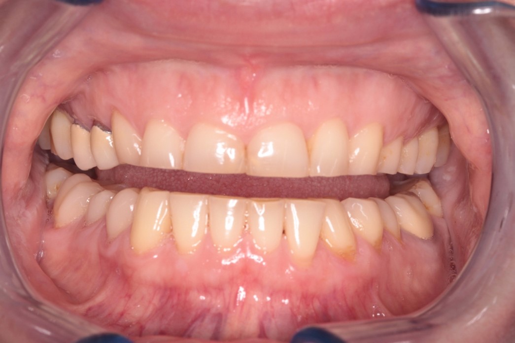 Réhabilitation complète sur dents naturelles ou implants - Avant
