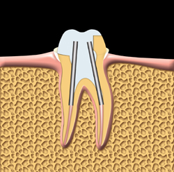 La dent est préparée pour la pose d’une couronne. Des pivots peuvent être utilisés pour tenir la couronne en place.