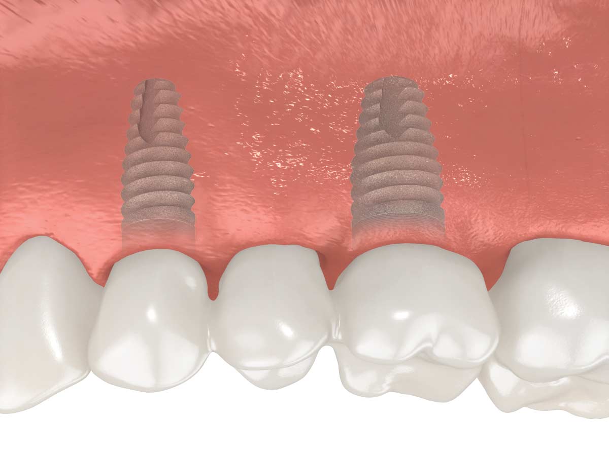 L’harmonisation avec votre dentition naturelle est ainsi à son meilleur!