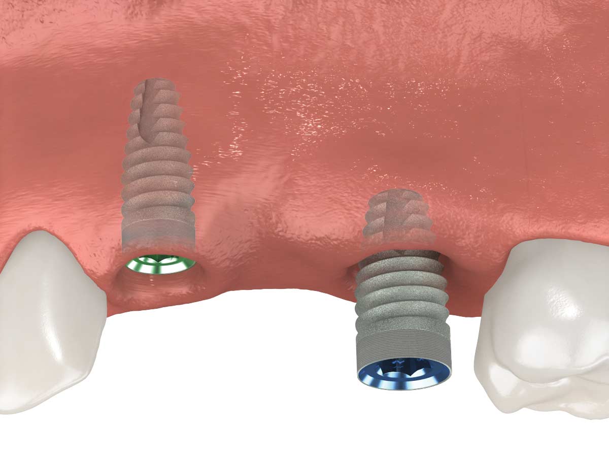 Après que les implants aient été insérés sans l’os sous la gencives, des piliers dentaires et des couronnes seront faits sur mesure.