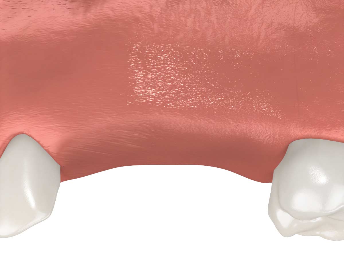 Que vous ayez une ou plusieurs dents absentes, il est possible de les remplacer par des implants dentaires sans que les dents naturelles ne soient touchées.